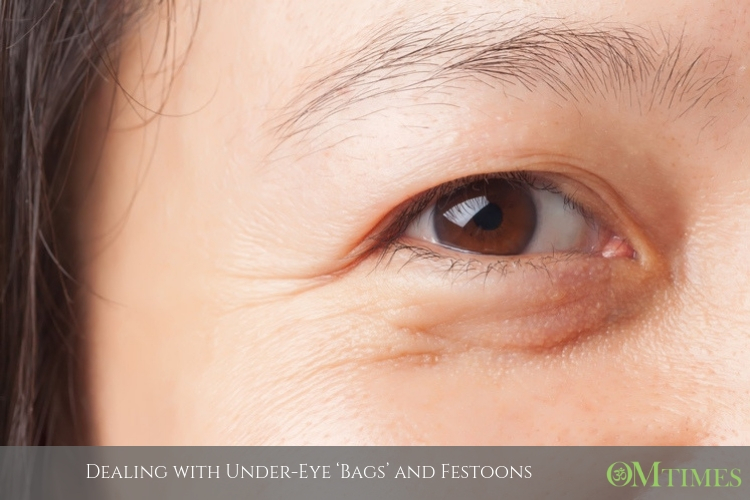 Dealing with UnderEye ‘Bags’ and Festoons OMTimes Magazine
