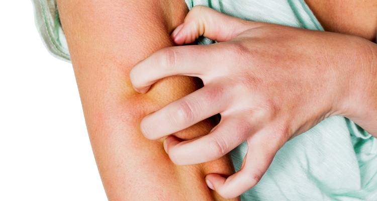 psoriasis_dermatits_natural-remedies_OMTimes