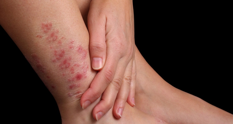 Alternative Answers for Psoriasis - OMTimes Magazine