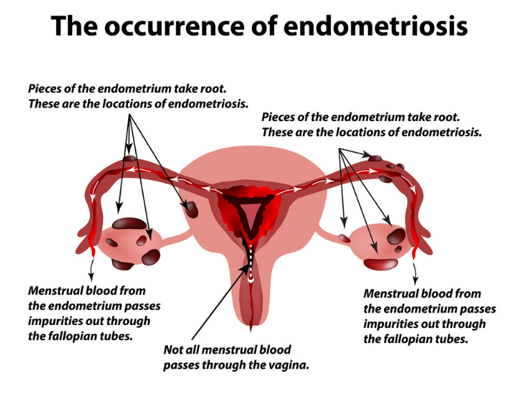 surgery for severe endometriosis