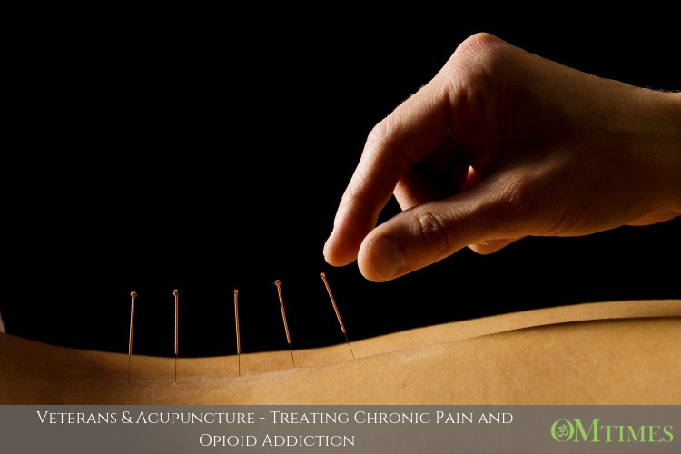 Veterans Acupuncture OMTimes