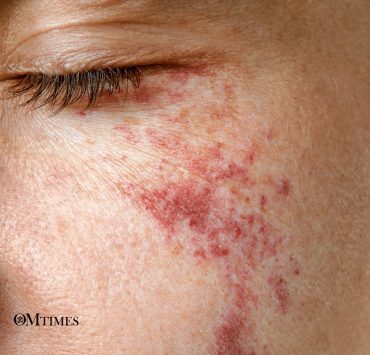 birthmarks OMTimes